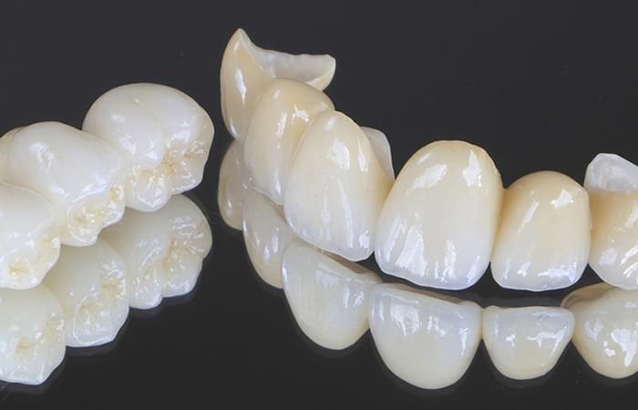 セラミック治療